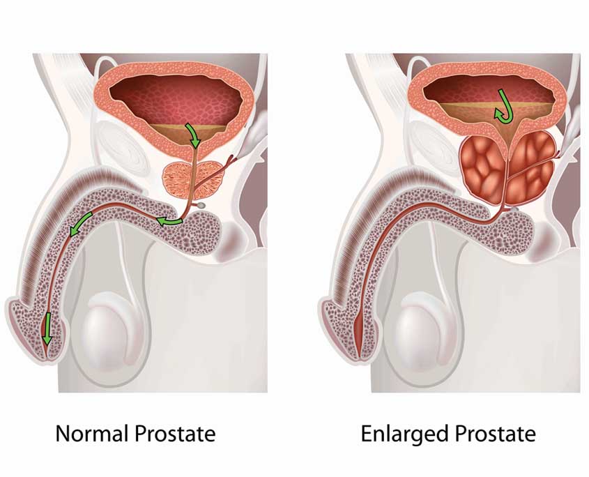 yperplasia-prostath